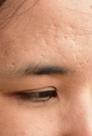 Tab Image Acne & Acne Scars